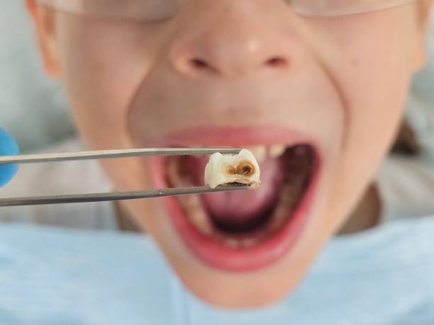 Best Emergency Tooth Extraction in Middletown, VA