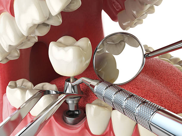 Best Emergency Tooth Extraction in Middletown, VA
